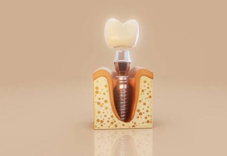 Patient-Centric Solutions: The Advantages of Dental Implant Services Patient-Centric Solutions: The Advantages of Dental Implant Services