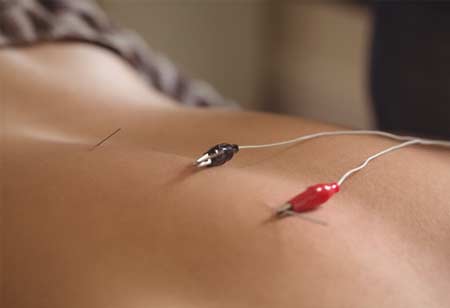 Acupuncture Fertility Treatment: Natural Support on Your Journey to Parenthood